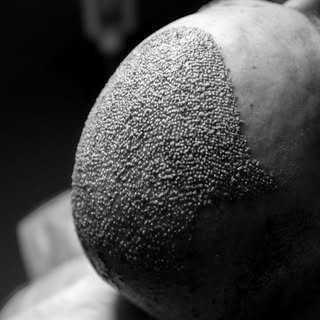 Direkt nach der Haartransplantation 
So sieht ein Kopf unmittelbar nach dem Eingriff aus. Jede Graft