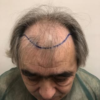 Μετά από επέμβαση 3212 τριχοθυλάκια. #fue #hairtransplant #hairtransformation