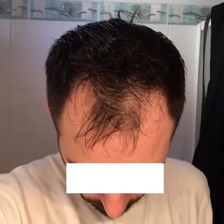 Τα αποτελέσματα μιλάνε από μόνα τους. #fue #hairtransplant #hairsurgeon