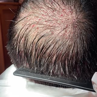 ΤΩΡΑ ΜΟΝΟ ΣΤΗΝ HAIR CLINIC ATHENS, ΤΕΛΕΙΩΣ ΑΚΟΥΡΕΥΤΟ ΚΑΙ ΑΞΥΡΙΣΤΟ FUE. ΚΑΝΟΝΤΑΣ ΜΕΤΑΜΟΣΧΕΥΣΗ ΜΑΛΛΙΩΝ