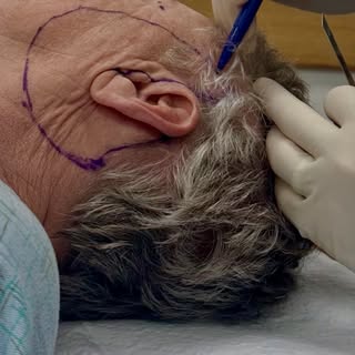 Most people think a facelift begins with an incision.

It doesn’t.

It begins with a plan.

Before s