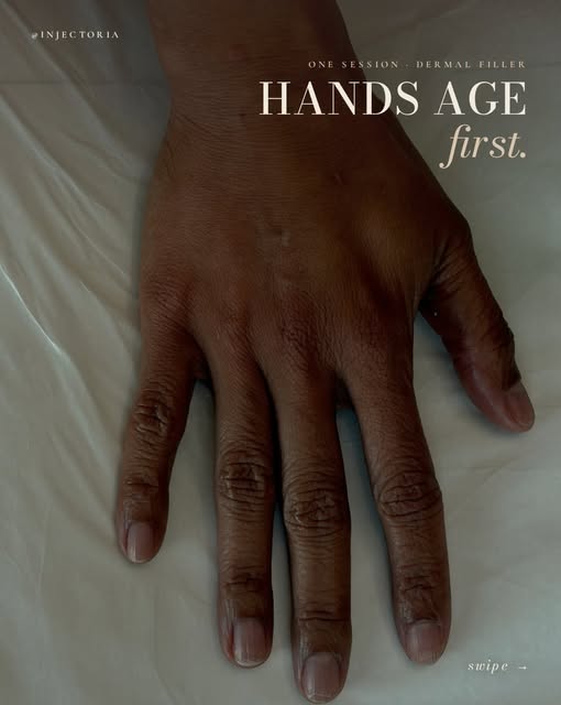 Your hands deserve a refresh too. 

At Skinsol Dermatology, we’re redefining hand rejuvenation with 