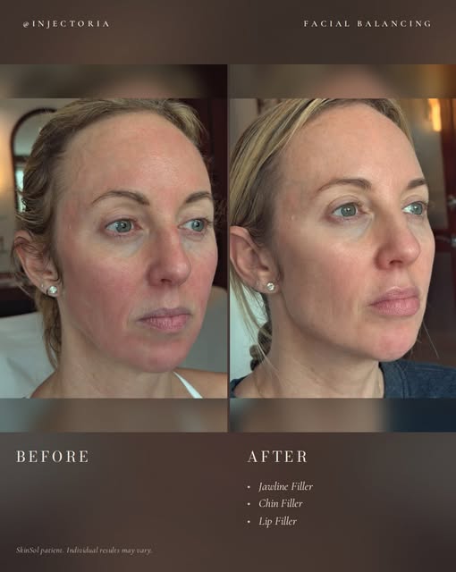 Facial balancing is never one-size-fits-all. 

Every face has its own unique proportions, and our go