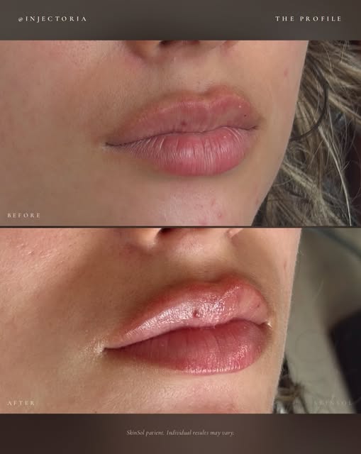 Lip enhancement isn’t just about volume—it’s about balance, shape, and symmetry. 💋

At Skinsol Derm
