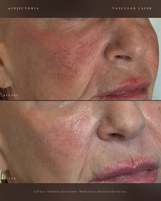 Tiny vessels, big difference. 

Facial spider veins and telangiectasias can create persistent rednes