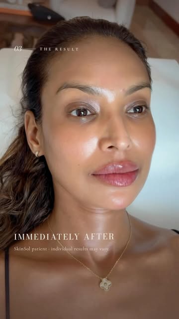 Natural, balanced, and customized to you. 

At SkinSol Dermatology, lip filler is never one-size-fit