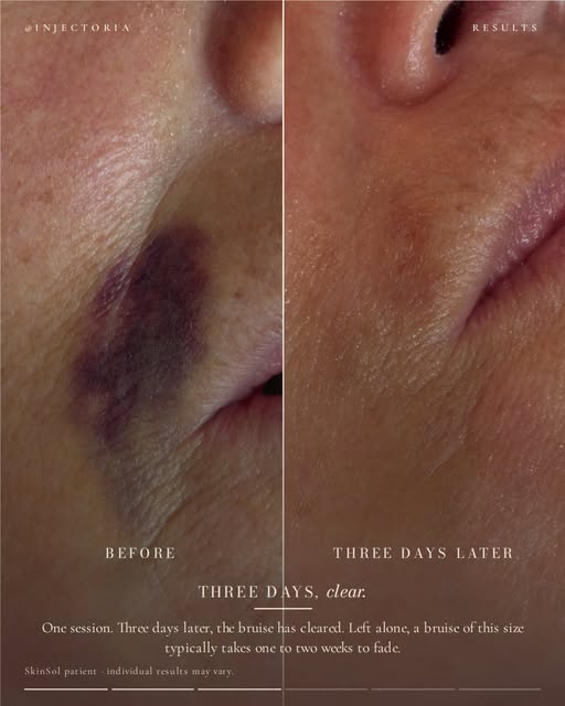 Bruising happens. Healing doesn’t have to feel like it’s taking forever. 

After certain treatments,