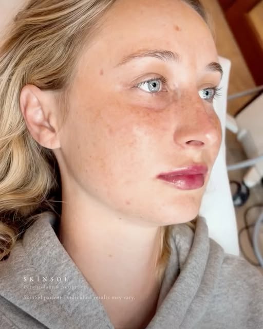 Natural-looking lips, always. 💋

At Skinsol Dermatology, our approach to lip enhancement is all abo