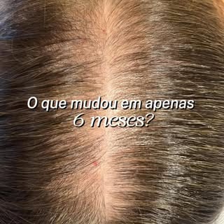 Se eu dissesse que esse resultado foi conquistado em apenas 6 meses… você acreditaria?

Essa pacient