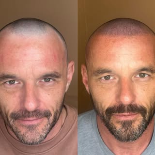 Directly after treatment, redness will subside within hours to leave that perfect blend 👌👌

Staffo