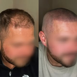 started as a density job to make a hair transplant look fuller, my client decided to just shave it a