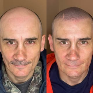 Directly after treatment, redness will subside within hours to leave that perfect blend 👌👌

Staffo