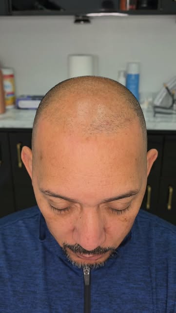 Building Density to create a fuller look while keeping the results natural and undetectable. 🔥

It’