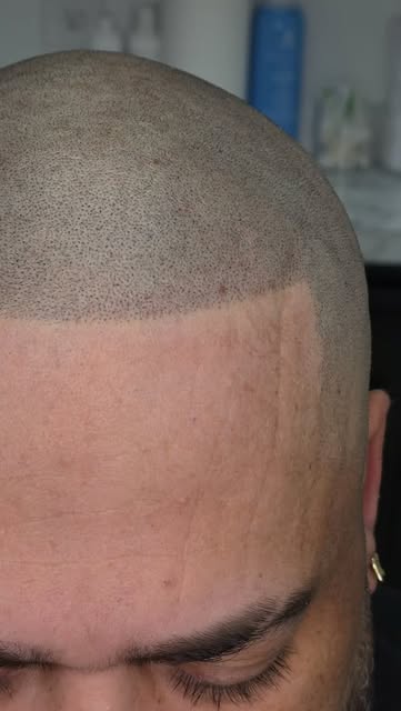 The Goal is Simple: Fuller, Natural, Undetectable!
We can make it look fuller but keep it natural.

