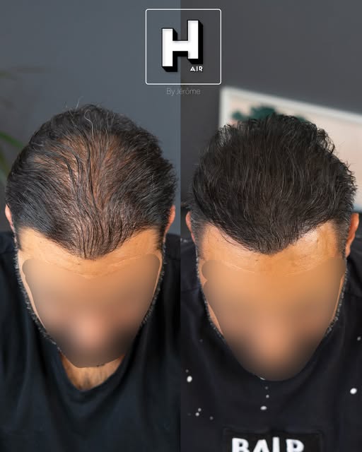 2 greffes de cheveux 🇹🇷🫠
🎯densité absente
🎯peau endommagée 
Solution : SMP ✅
Une prise en charg