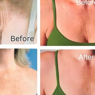 Introducing the EXCLUSIVE Chest Lift! Upper Chest Rejuvenation aka 
"The Chest Lift" has been develo