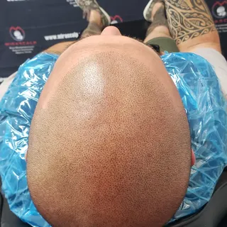 The Work Speaks For Itself. If you are going bald or know someone that is experiencing hairless, cal