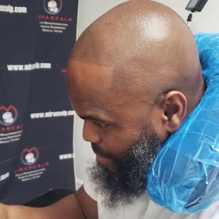 We specialize in creating a natural 5 o clock shadow soft hairline for customers struggling with bal