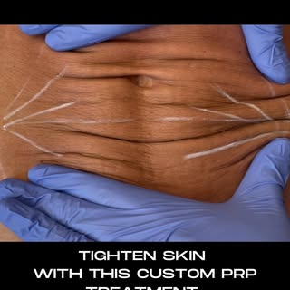 “PRP Is The Treatment Celebrities Swear By” @voguemagazine 

Now is the best time to rejuvenate your