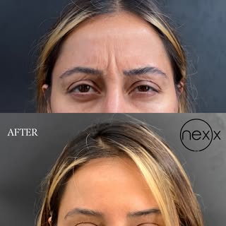 Botox Results | 2 Weeks Post-Treatment

These before and after photos show the difference Botox can 