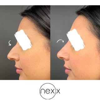 Refine your profile without surgery. ✨💉

A dermal filler to enhance the shape and balance of the no