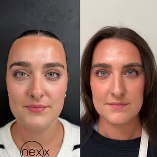 Botox Results | 1 Month Post-Treatment

Treatment included:
• Forehead (frontalis)
• Glabella (frown