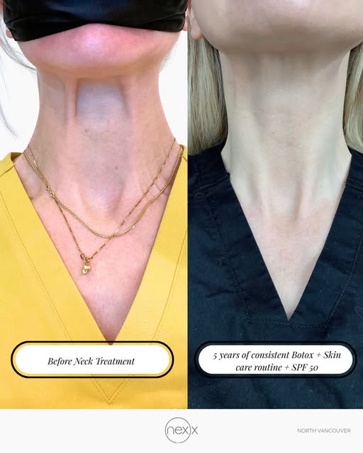 Neck rejuvenation: a long-term approach 

These photographs were taken nearly 5 years apart, demonst