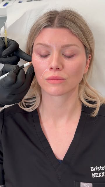 Improve nasolabial folds and undereye circles naturally with PRP (Platelet-Rich Plasma) - a regenera
