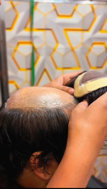 #hairpatchdelhi #hairpatch #hairtransformation #transformation #hairwigs