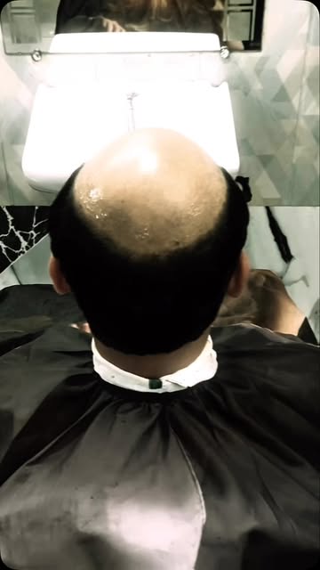#hairpatchdelhi #hairtransformation #hairpatchdilshadgarden#hairwigs #professionalhairstylist✂️