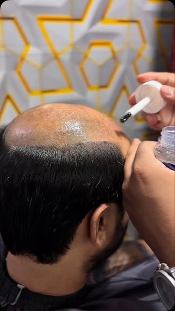 #hairpatchdelhi #hairpatch #hairtransformation #hairwigs #delhincr
