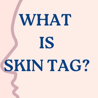 What Are Skin Tags? 🤔✨

Skin tags are small, harmless growths that can appear on your skin. 

While