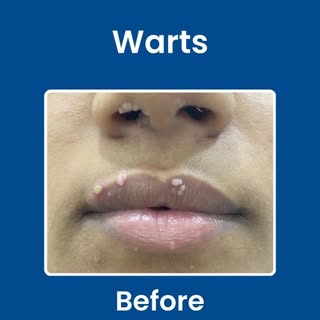 Those tiny bumps you keep ignoring?
They don’t disappear on their own.
Warts can 𝘀𝗽𝗿𝗲𝗮𝗱, 𝗴𝗿�