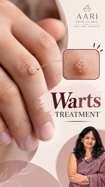Warts ko ignore mat karo 👀

Body par chhote-chhote warts dikh rahe hain? Unhe baar-baar chhedna, ka