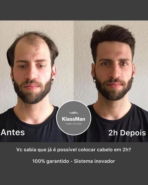 Prótese Capilar é um sistema inovador em que possibilita a colocação de cabelo em apenas 2h! 
Sem do