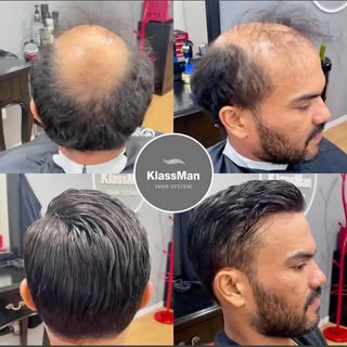 Prótese Capilar é um sistema inovador em que possibilita a colocação de cabelo em apenas 2h! 
Sem do