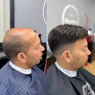 Prótese Capilar é um sistema inovador em que possibilita a colocação de cabelo em apenas 2h! 
Sem do