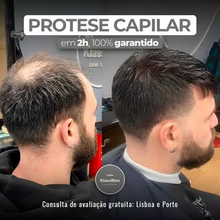 Prótese Capilar é um sistema inovador em que possibilita a colocação de cabelo em apenas 2h! 
Sem do