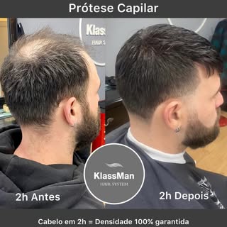 Prótese Capilar é um sistema inovador em que possibilita a colocação de cabelo em apenas 2h! 
Sem do