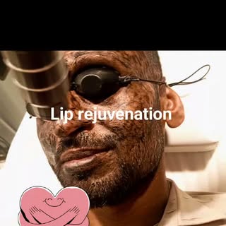 #liprejuvenation #lippigmentation #liplaser