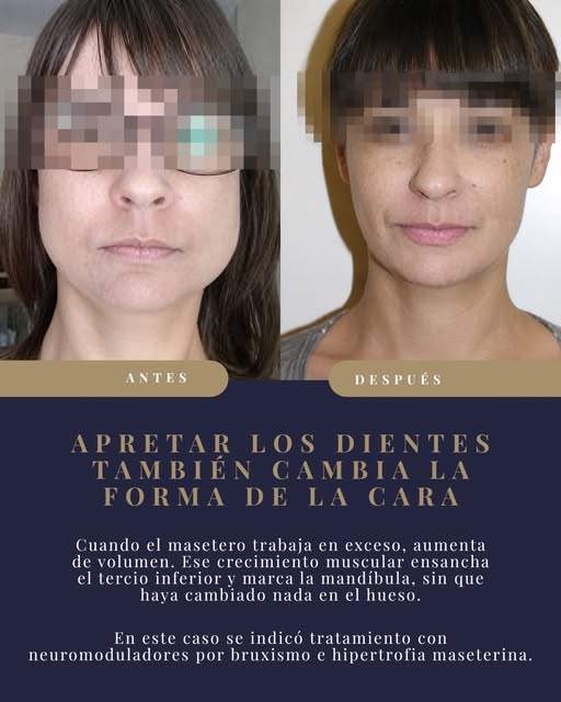 Apretar los dientes de forma mantenida no solo se nota en el esmalte. También se nota en la forma de