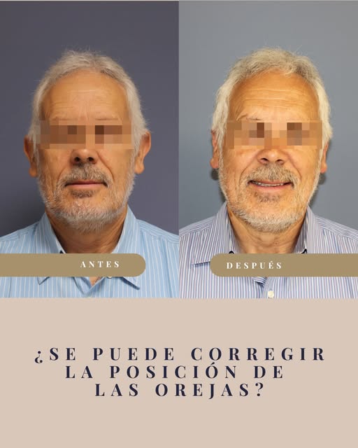 La posición de las orejas puede afectar a la armonía del rostro, y en algunos casos también generar 