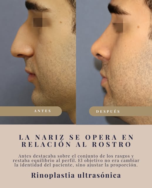 Una nariz valora en relación con el mentón, los labios y el tercio medio del rostro.

En este caso s