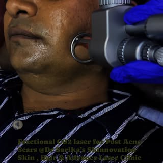 Fractional CO2 Laser for Post acne scars and pits @Dr Sarika’s Skinnovation Skin , Hair & Advance La