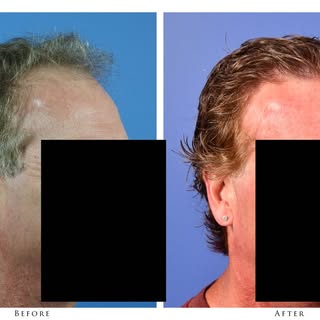 #WondrousWednesday 59-year-old male has a strip transplant of 2,884 Grafts with Dr. Gabel - Postop p