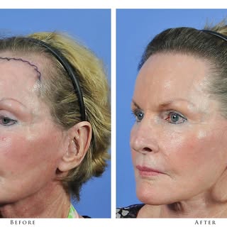 #ThrowbackThursdays A 65-year-old female patient was interested in restoring her frontal hairline an