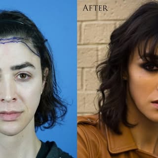 #hairtransplants Understanding the differences of male and female hairlines is of critical importanc
