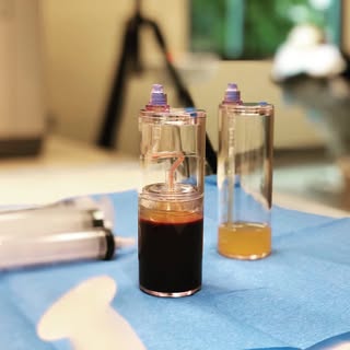 #FollicleFriday ACELL and PRP can be used on a non-surgical basis for treating thinner, miniaturized