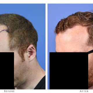 This 36-Year-Old Male had a FUT Strip Harvest Transplant of 3,361 Grafts with Dr. Gabel I. One sessi