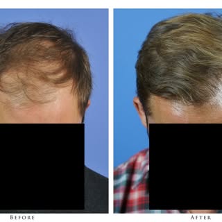 #MondayMotivation - Some positive news! This 42-year old gentleman had thinning at the frontal and c